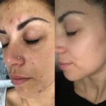 HydraFacial (5)